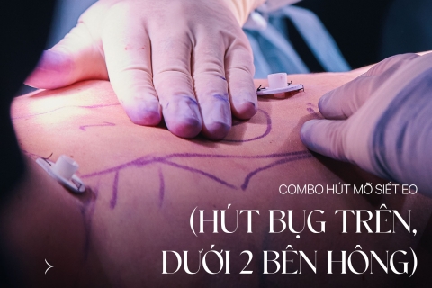 Combo Hút mỡ siết eo (hút mỡ bụng trên, dưới, 2 bên hông)